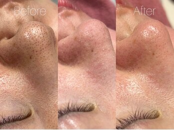 ビヨンド リンク(BEYOND L'INK)/韓国式3D毛穴洗浄