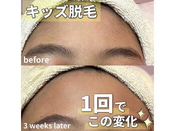 サロン(SALON)/キッズ脱毛：顔