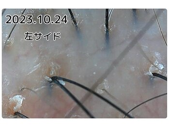 エルール トータルビューティ(Aileure total beauty)/育毛促進ケア　