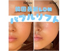 バブルビューティー(Bubble beauty)の雰囲気（話題の最新機器LDM水玉リフティング♪みずみずしいハリ艶お肌に）