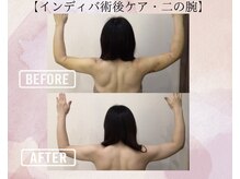 オキシー グレイス 小倉店(OXY Grace)/【インディバ術後ケア・二の腕】