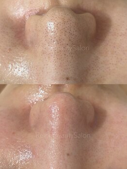 レーヌ(Reine)/毛穴＋ピコジェット＋臍帯原液