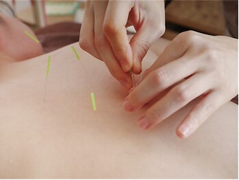 ケロピー整体 鍼灸院 田園調布(Keropy整体 鍼灸院)の写真/【鍼が初めての方にもおススメ!】不眠/眼精疲労など不調がある方へ《自律神経調整鍼》を1度お試しください!