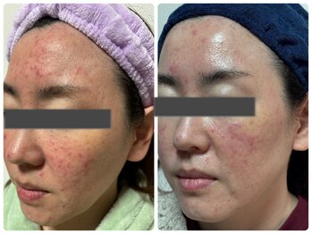 アズ(AZU)/繰り返しニキビケアを根本改善!