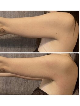 ワイケー(yk)の写真/脂肪撃退♪脅威の40%☆高濃度溶解液使用!なかなか減らない憎き脂肪とお別れしましょう♪ダウンタイムなし!