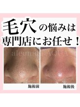 アルムダアクア 天王寺店(Aleumda AQUA)/毛穴エクストラクションプロ大阪