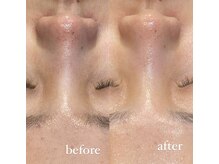 レシェルサロン(Lechelle Salon)/ハーブピーリング