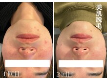 モノ(MONO)/【顔脱毛】