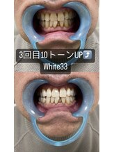 アイブロウ33 久留米店/【ホワイトニングBefore After】