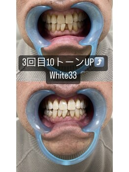 アイブロウ33 久留米店/【ホワイトニングBefore After】