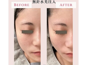 レクラ バイ ドクターエイチ(L'ECLAT by Doctor.H)/無針水光注入”美容液真皮導入”