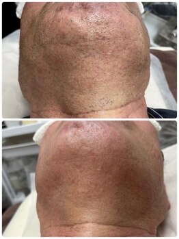 エアリアル 大牟田店/剃りづらいあご裏も♪