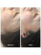 爽健美/美容鍼効果