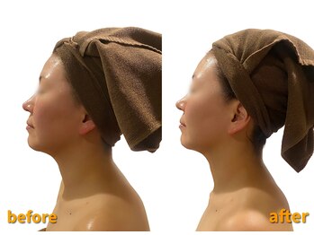 ビュップ 鶴ヶ峰店(美up)/グロッティ血管拡張コース