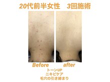 ビカム(become)/背中ニキビに働きかける！