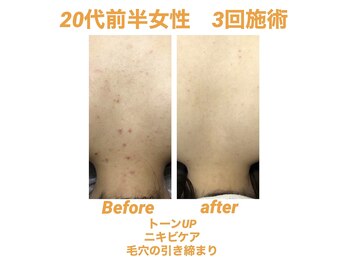 ビカム(become)/背中ニキビに働きかける！