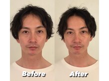 コルミチョン サロン(骨美整 salon)/Before・After &nbsp;1回施術