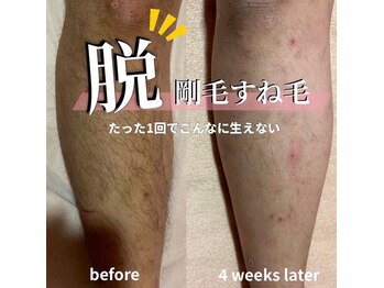 サロン(SALON)/メンズ脱毛：脚