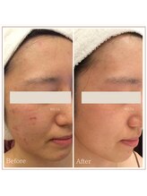 ベルタ 仙台店(BELTA)/【ケア前→後】