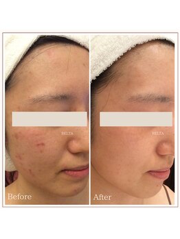 ベルタ 仙台店(BELTA)/【ケア前→後】