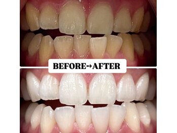 ホワイトニングサロン 豊中/Before&After美白ホワイトニング