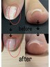【巻き爪ケア初めての方】くい込みが気になる!ジェルでするフット巻き爪ケア