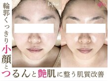 ソワンドビジュー(soin de bijew)/インディバ/ハーブピーリング