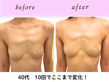 ビーハピネス 京都西院(B-Happiness)/40代月2回5ヶ月でここまで変化！