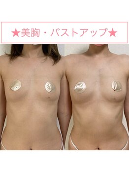 アカリ(AKARI)/美胸・バストアップ鍼灸