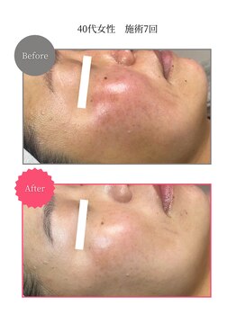 ボータン 恵(Beau Temps)/ウルトラ光トーニング/シミ改善