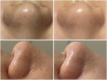 ベル(Belle)の写真/【最先端の技術導入！毛穴洗浄】毛穴の黒ずみ・ザラつき・開き・くすみ・乾燥等、お肌の悩みを徹底改善！