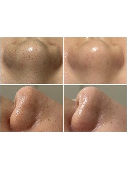 毛穴ケアをしたい