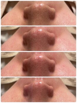 ネムレル森(Nemureru森)/毛穴洗浄【水巻/八幡西区/折尾】