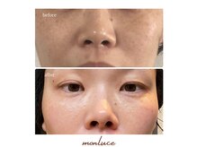 エステティック モンルーチェ(Esthetique monluce)の雰囲気（シミ、しわ、たるみ老化によるトラブル改善おまかせください！）