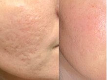 マリヴェリーテ(Mari verite)/30代ニキビ凸凹悩みBeforeAfter