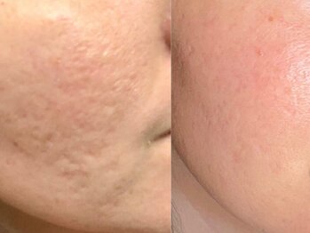 マリヴェリーテ(Mari verite)/30代ニキビ凸凹悩みBeforeAfter