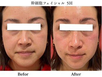サロン アイプラス(salon i plus)の写真/年齢と共に失われるハリとツヤを引き出し、たるみ・シミ・シワ・毛穴などもトータルでケア！#幹細胞#小顔