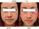 サロン アイプラス(salon i plus)の写真/年齢と共に失われるハリとツヤを引き出し、たるみ・シミ・シワ・毛穴などもトータルでケア！#幹細胞#小顔