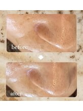 プライベートサロン ノエル(Noel)/毛穴洗浄