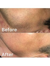 サーティースリー 横浜元町(Thirty3)/【脱毛】Before/After