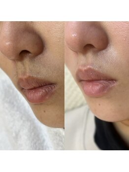 ラティーク 諫早西口店/マリムーブフェイシャルWAX