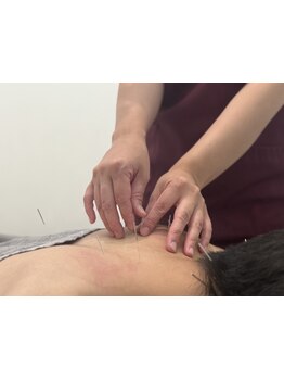 鍼灸施術を受けたい