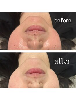 レイモード(Ray mode)/顔脱毛&カスタードパック