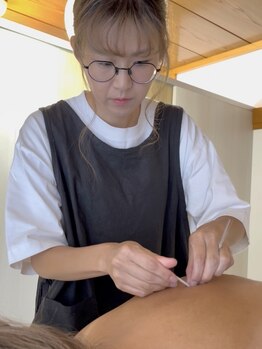 はり屋ドリームの写真/鍼を打つだけで自律神経の反射が血流をUP→冷え・むくみに効果的♪リフトアップなどの美容目的にも◎