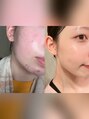 ブレデサガ(B’lady Saga) 私も肌荒れに悩んでいた過去があります。一緒に解決しましょう!