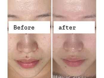 アリス(ALICE)/パレットピールで毛穴スッキリ!