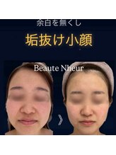 ボーテヌール(Beaute Nheur)/マトリックス＋メソガン