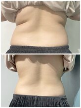 OBS新潟整骨院/脂肪冷却！