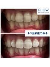 グロウ 上野店(GLOW)/3回来店BeforeAfter【10】