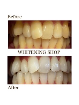 ホワイトニングショップ 函館店(Whitening Shop)/Before &Afterホワイトニング